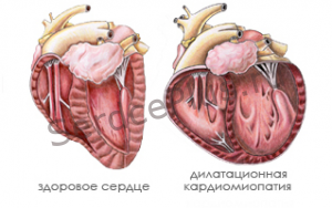 Дилатационная кардиомиопатия