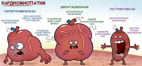 Дилатационная кардиомиопатия
