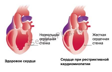 Рестриктивная кардиомиопатия