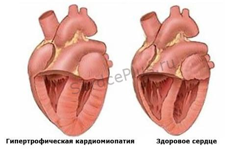 Гипертрофическая кардиомиопатия