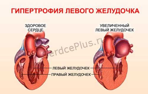 Гипертрофия миокарда
