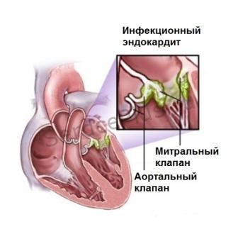 Инфекционный эндокардит