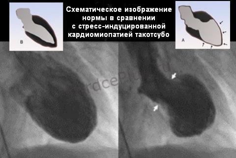 Кардиомиопатия Takotsubo