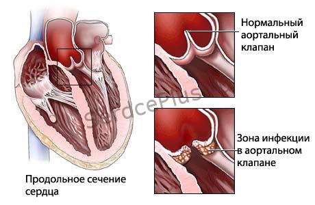 Лечение инфекционного эндокардита