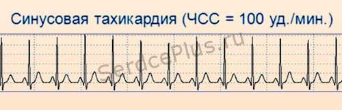 Нарушения автоматизма