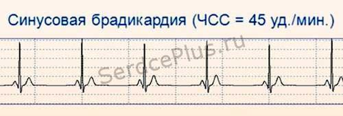 Нарушения автоматизма