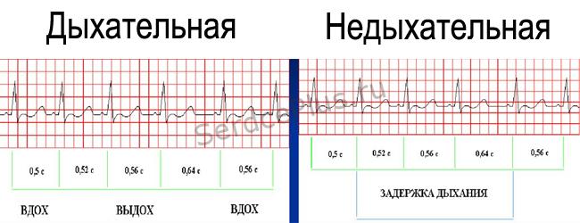 Нарушения автоматизма
