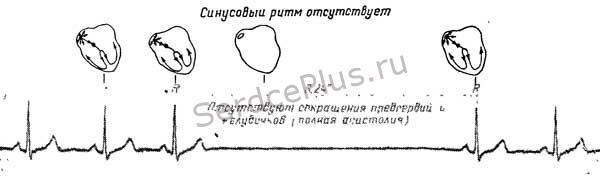 Нарушения автоматизма