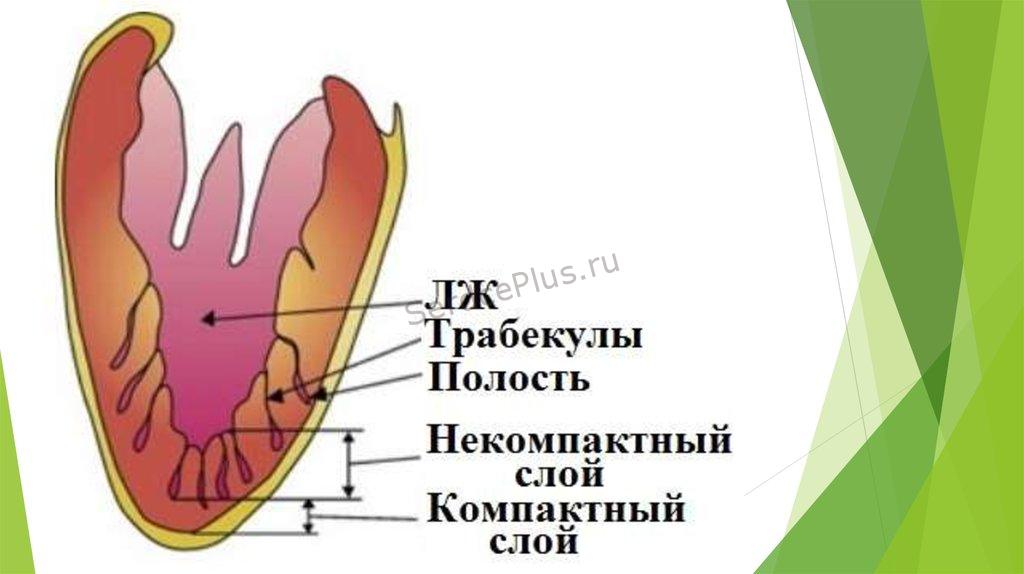 Некомпактный миокард желудочков