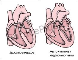 Рестриктивная кардиомиопатия