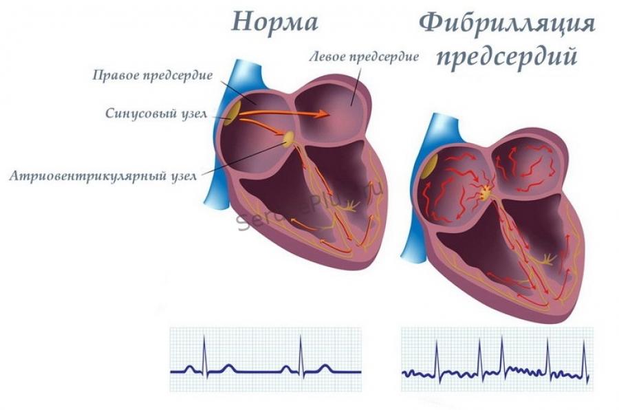 Лечение фибрилляции предсердий
