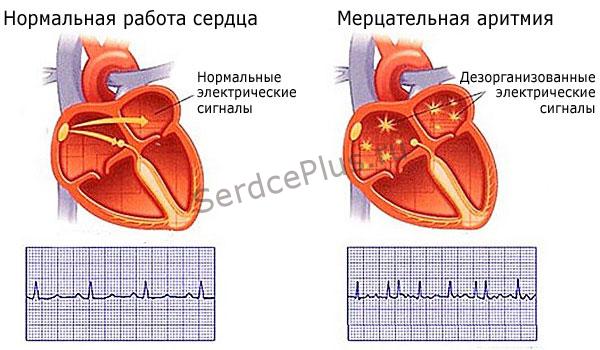 Мерцательная аритмия