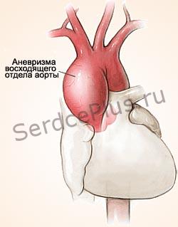 Аневризма аорты