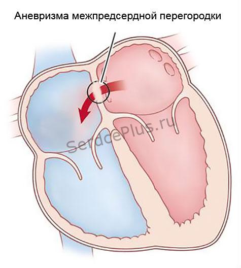Малые аномалии сердца