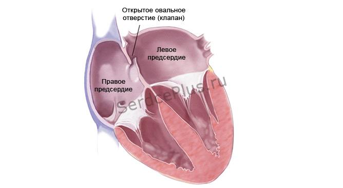 Малые аномалии сердца
