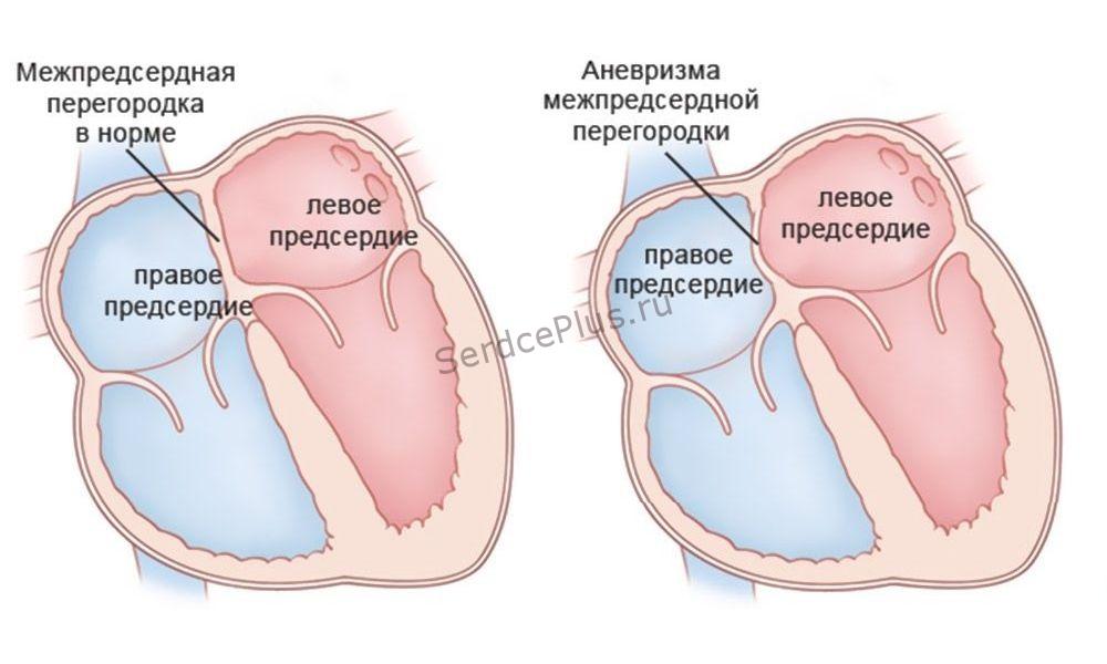 Малые аномалии сердца