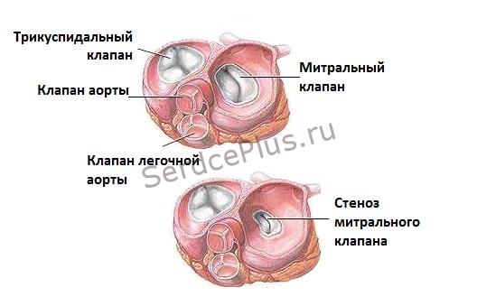Митральный стеноз
