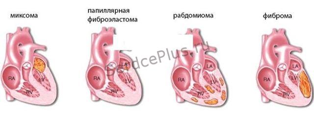Опухоли сердца