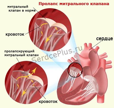 Пролапс митрального клапана