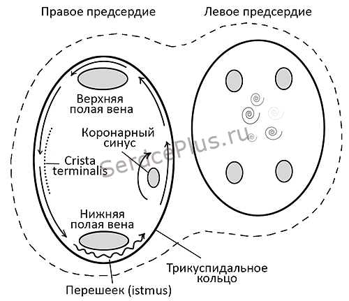 Трепетание предсердий