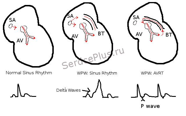 Синдром WPW