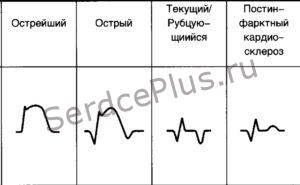 Инфаркт миокарда-стадии развития и локализация