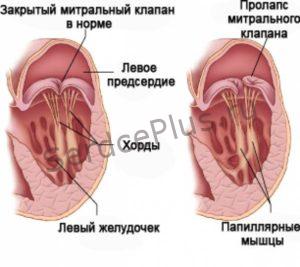 Причины митральной недостаточности