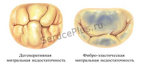 Причины митральной недостаточности