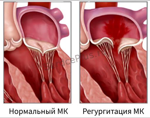 Диагностика митральной недостаточности