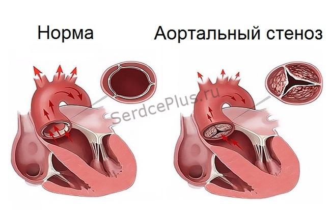 Аортальный стеноз