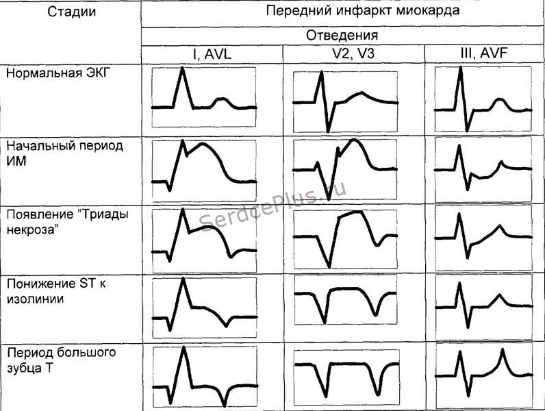 Динамика инфаркта миокарда на ЭКГ