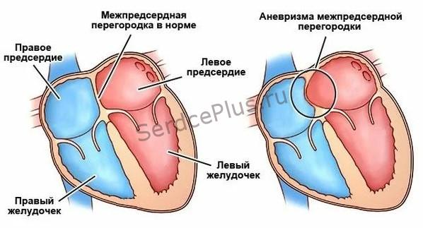 Аневризма межпредсердной перегородки