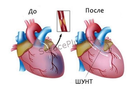 Стентирование или шунтирование