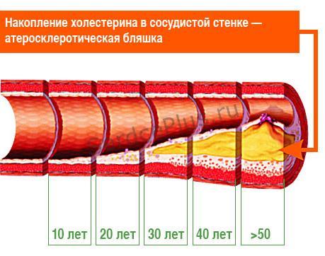 Атеросклероз - причина всех бед. Как избежать разрушения сосудов?