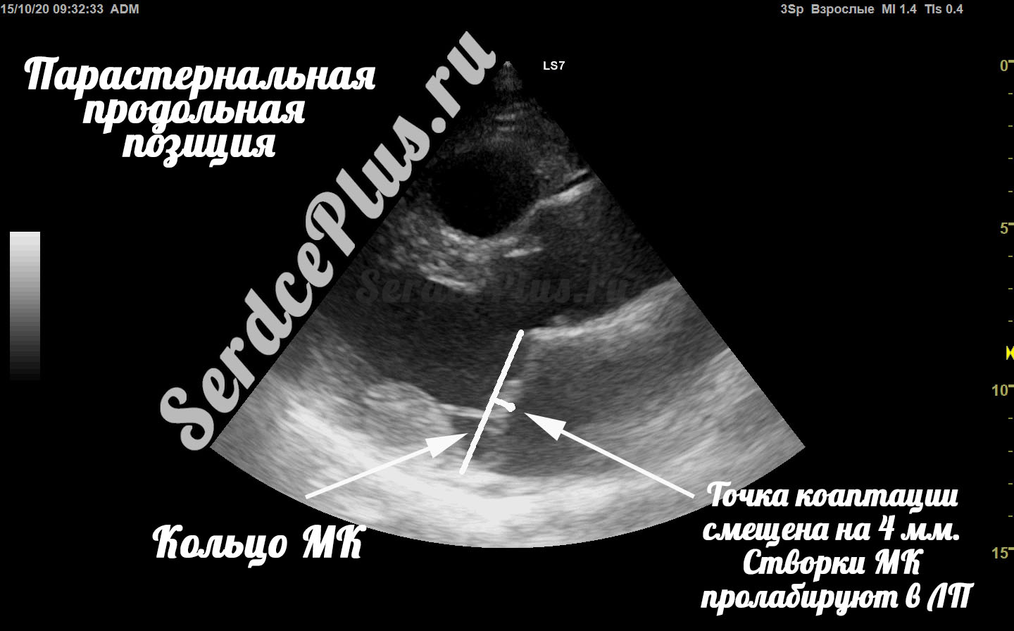 Пролапс митрального клапана на эхокардиографии