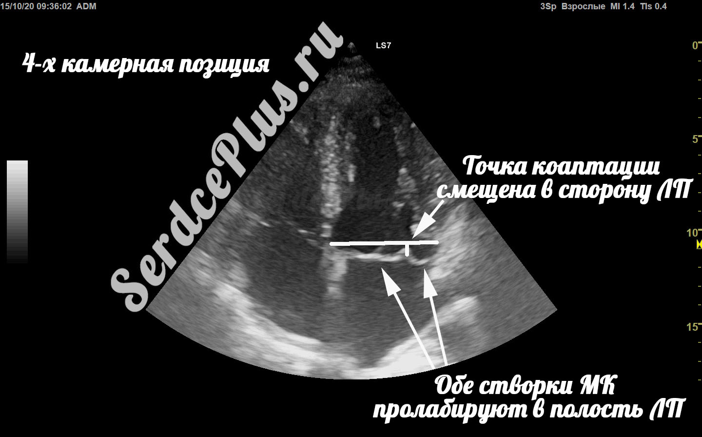 Пролапс митрального клапана на эхокардиографии