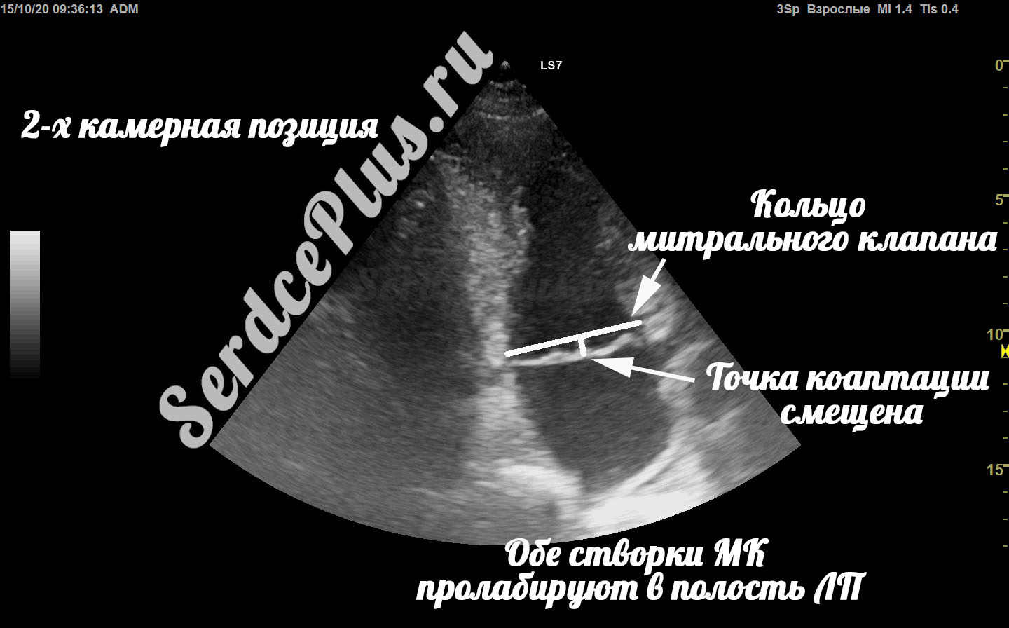 Пролапс митрального клапана на эхокардиографии