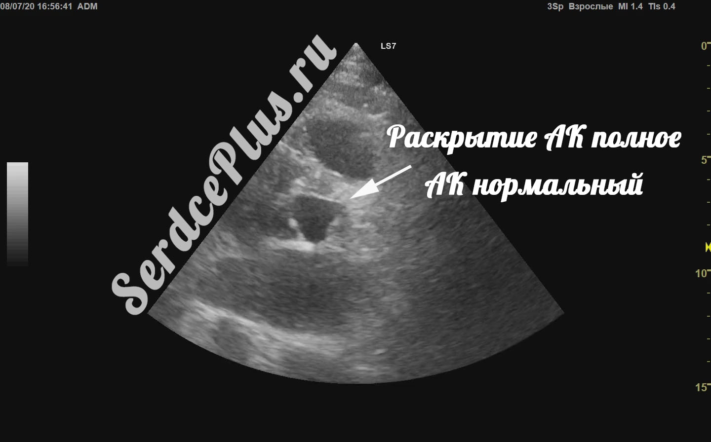 Обструкция выходного отдела левого желудочка при ГКМП