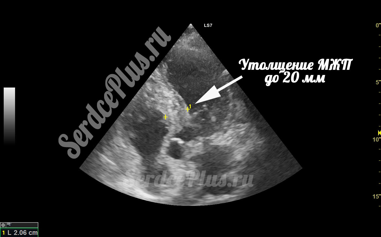 Обструкция выходного отдела левого желудочка при ГКМП
