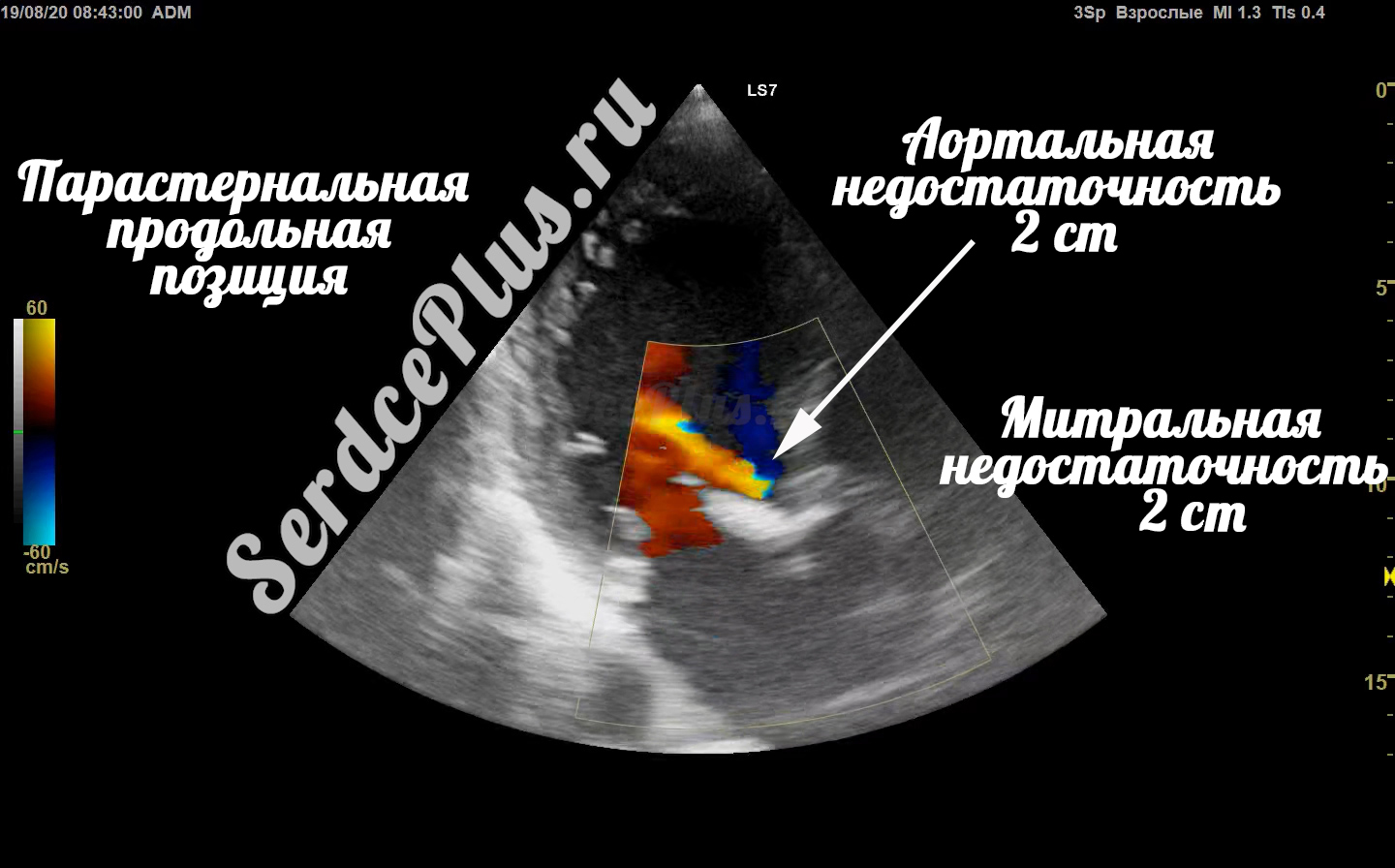 Диффузная гипокинезия всех стенок сердца. ФВ 24%