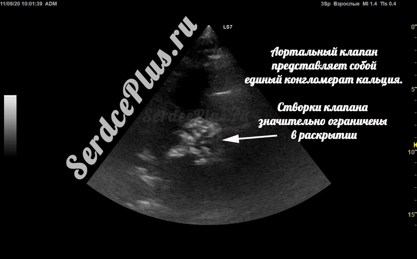 Аортальный стеноз 3 степени