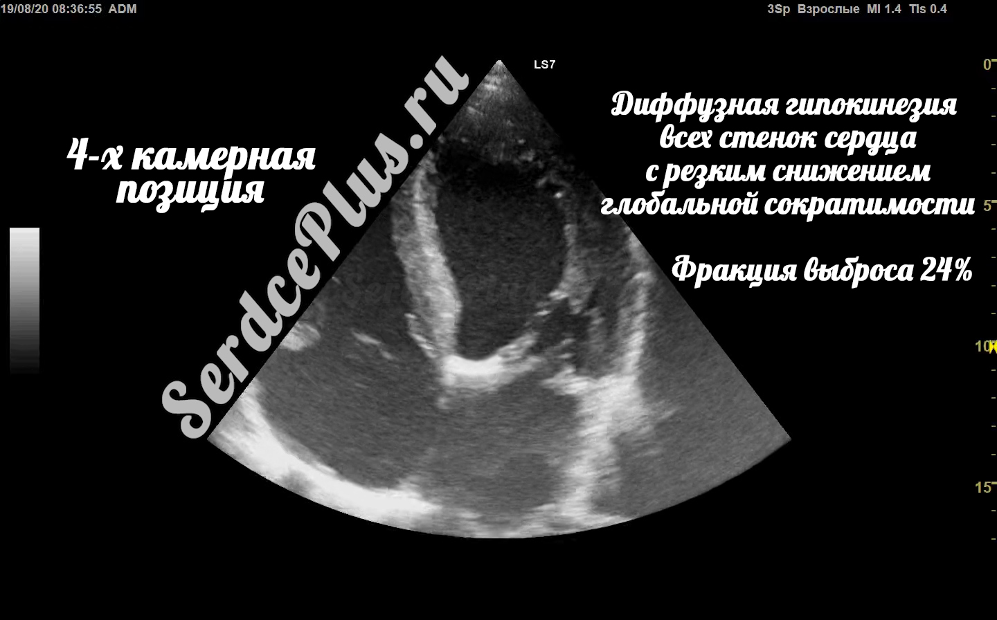 Диффузная гипокинезия всех стенок сердца. ФВ 24%
