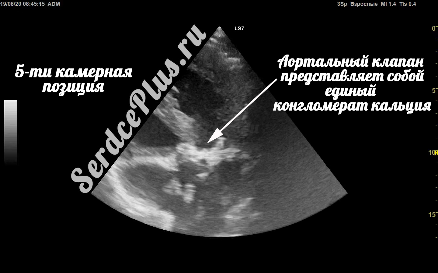 Диффузная гипокинезия всех стенок сердца. ФВ 24%