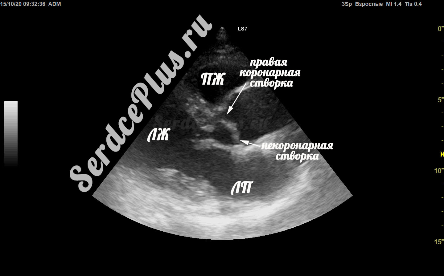 створки аортального клапана на эхокг