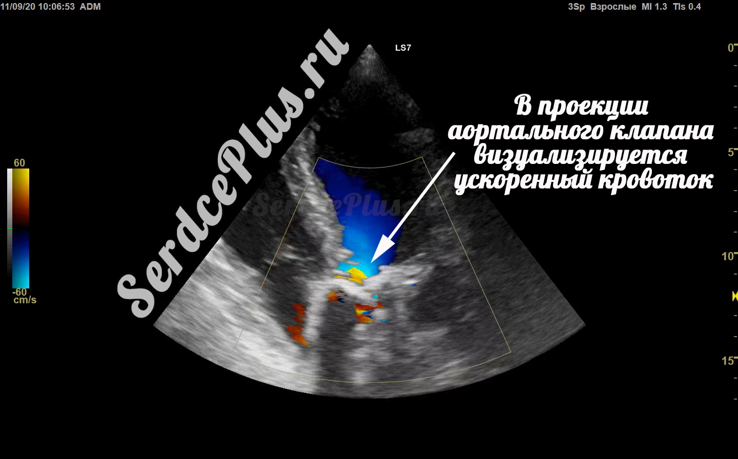 Аортальный стеноз 3 степени. Диффузная гипокинезия левого желудочка
