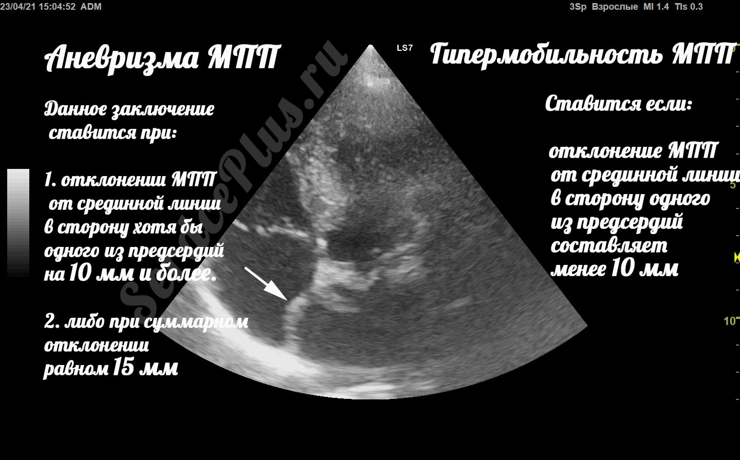 Аневризма МПП и гипермобильность МПП. В чем отличия?