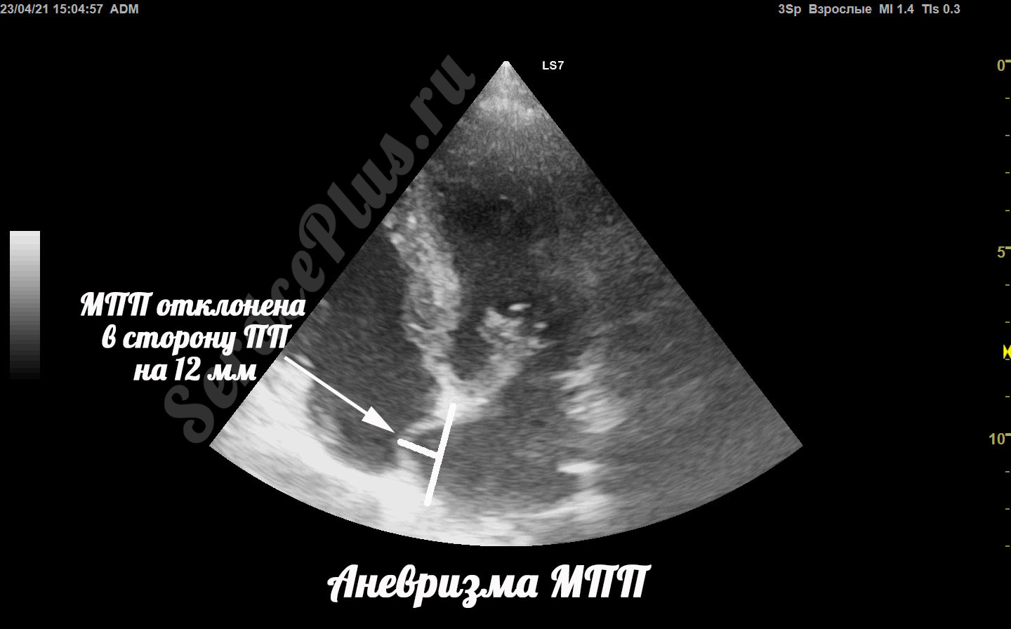 Аневризма МПП и гипермобильность МПП. В чем отличия?