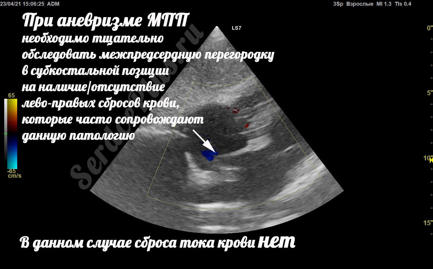 Аневризма МПП и гипермобильность МПП. В чем отличия?