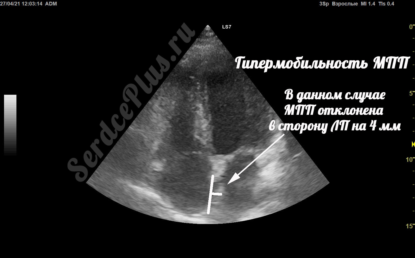 Аневризма МПП и гипермобильность МПП. В чем отличия?