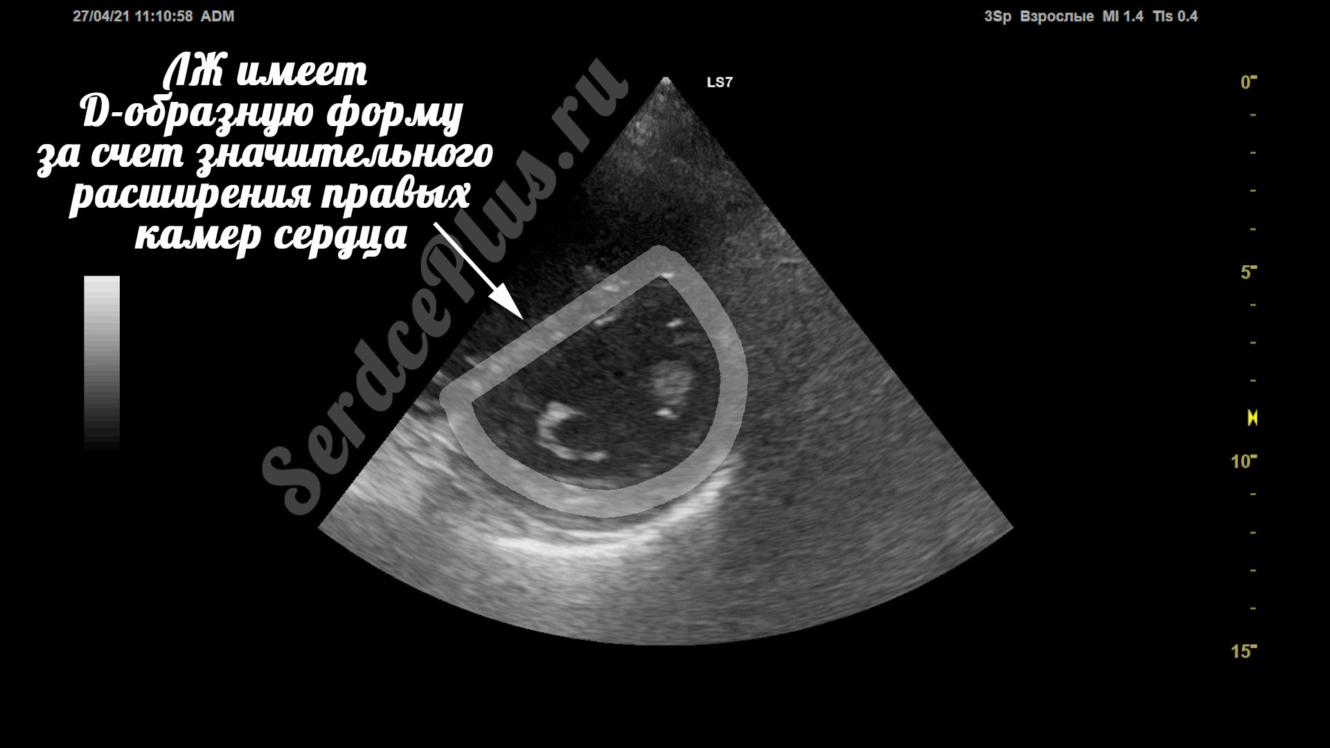 Карциноидный синдром и миксоматоз на ЭхоКГ